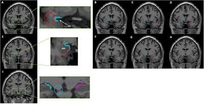 The role of the piriform cortex in temporal lobe epilepsy: A current literature review